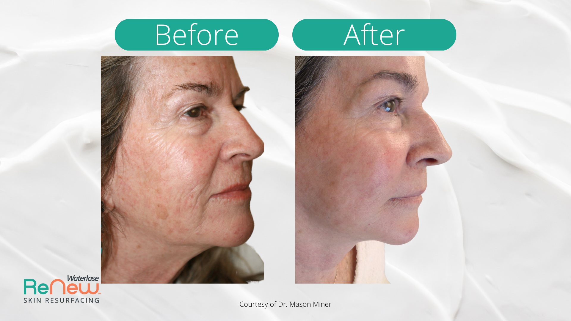 The image shows a before-and-after comparison of a person s skin, highlighting the results of a cosmetic treatment with text indicating  before  and  after.