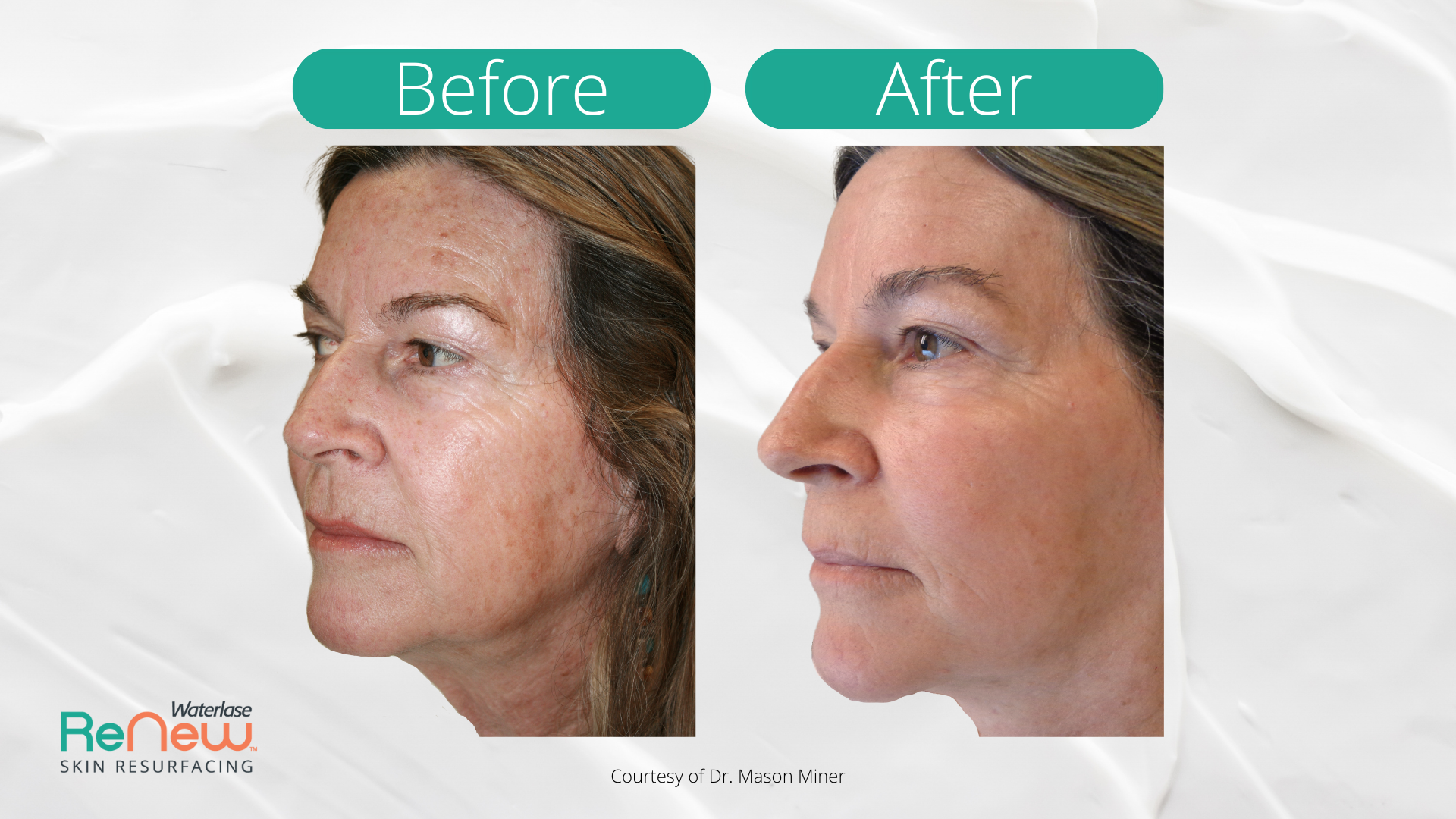 The image shows a before-and-after comparison of facial rejuvenation treatment, with visible improvements in skin texture and firmness after the procedure.