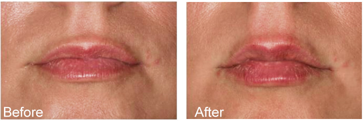 The image shows a series of four photographs of a person s face with cosmetic treatments, showcasing a transformation from before to after.