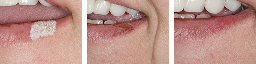 The image shows a close-up view of a person s teeth with visible staining or discoloration, likely from a product or substance applied to them, presented across four panels, possibly for comparison or demonstration purposes.