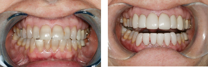 This is a split-screen photograph showing two different stages of teeth whitening treatment  before and after.
