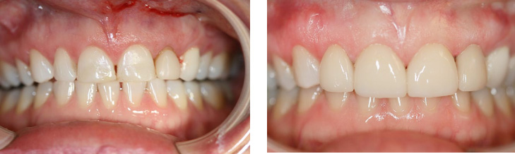 The image displays a side-by-side comparison of a person s teeth before and after dental treatment, showcasing the transformation from discolored and misaligned to clean and aligned.
