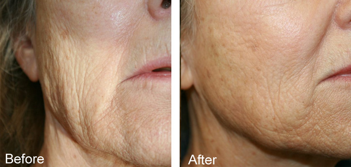 The image shows a side-by-side comparison of a person s skin before and after a cosmetic treatment, highlighting the results achieved by the procedure.