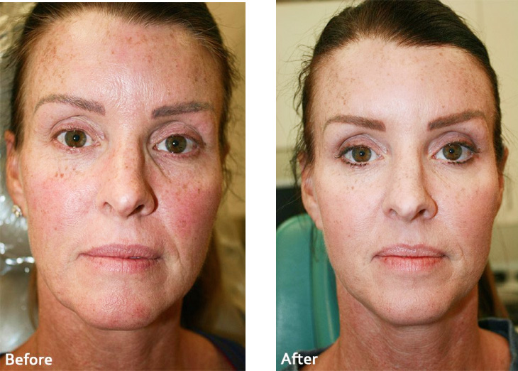 The image shows a person s face with three different stages of cosmetic treatment, presumably for skin rejuvenation or acne removal, with before, during, and after results displayed side by side.