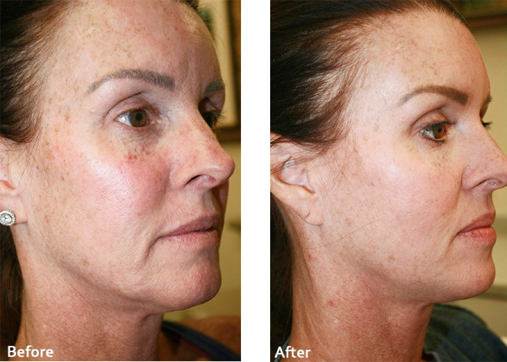 The image shows a person s face with three different stages of skin treatment, likely before and after a cosmetic procedure, emphasizing the results achieved by the treatment.