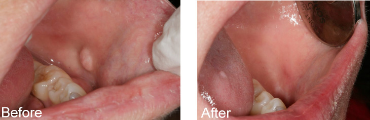 The image shows a close-up view of a person s mouth with visible teeth and gums, before and after what appears to be a dental procedure, with a focus on the transformation from redness to healing.