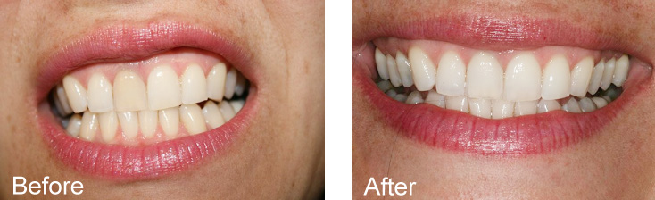 The image displays a woman s face with two different sets of teeth and lips, showcasing the results of dental work before and after the procedure.