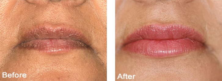 The image shows a split-screen comparison of a person s face before and after cosmetic treatment, with text indicating the result of the treatment.
