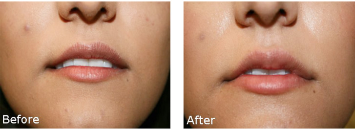 The image shows a close-up of a person s face with two different expressions, before and after lip filler, displayed side by side.