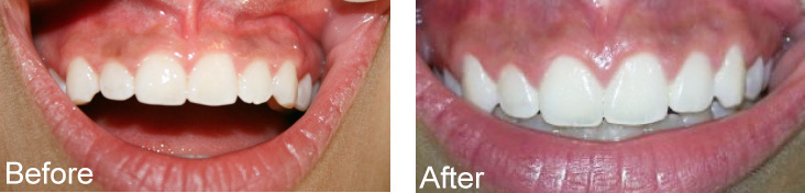 The image shows two side-by-side photographs of a person s teeth undergoing a cosmetic dental procedure, with one photo showing a mouth with teeth before treatment and the other after, highlighting the transformation achieved by the treatment.