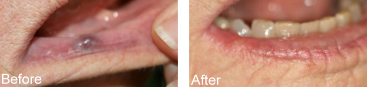 The image shows a person s mouth with teeth removed, and there is text indicating an  after  view of dental work.