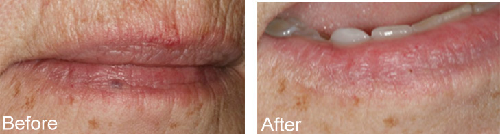 The image shows a person s face with two different states of their lips, before and after treatment, indicating cosmetic enhancement or medical correction.