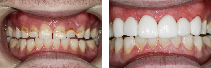 The image displays two photos side by side of a person s teeth before and after dental treatment, showcasing the transformation from yellowed and stained teeth to clean, white teeth.