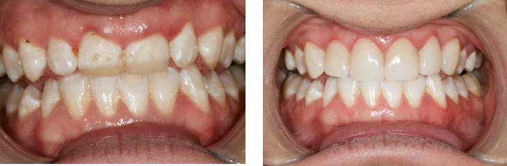 The image shows two close-up views of a person s teeth with significant discoloration and decay, showcasing poor oral hygiene.