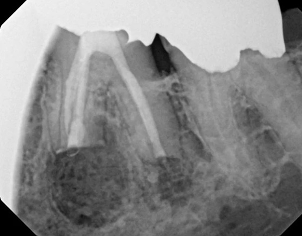 The image shows a close-up view of a human tooth with dental implants, taken from an X-ray perspective.