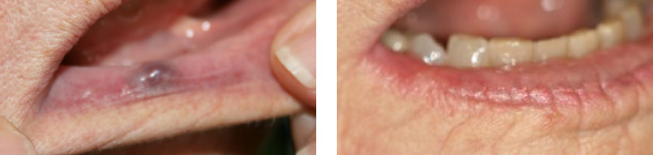 The image shows a close-up of an elderly person s mouth with multiple teeth missing, and there appears to be some form of infection or irritation on the gums.