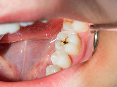 An up-close photo of an open mouth with teeth showing, revealing an oral infection or inflammation, possibly indicative of a dental issue requiring attention.