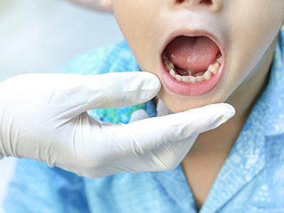 A young child receiving dental care with an open mouth, surrounded by medical equipment including gloves and a dental chair.