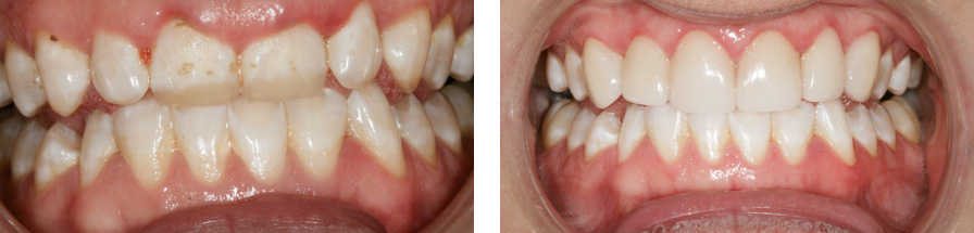 The image shows two close-up photographs of teeth with varying degrees of discoloration and decay, suggesting dental health issues.