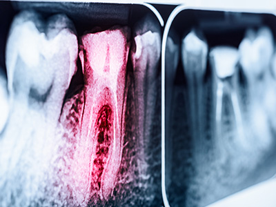 The image shows a dental X-ray with a focus on a red area, possibly indicating a cavity or issue within the tooth structure.
