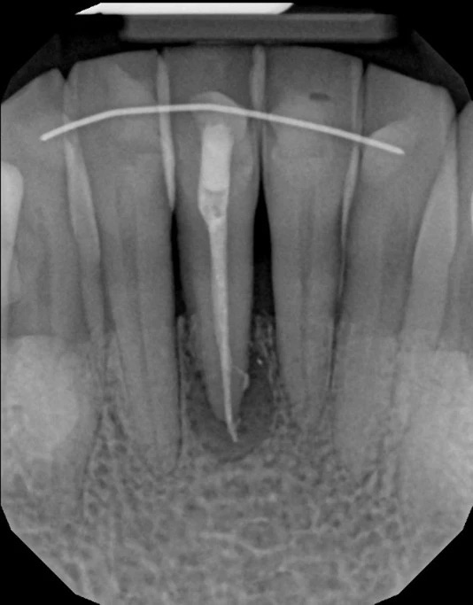 An X-ray image showing an orthodontic appliance, likely a bracket, attached to a tooth with a metal wire extending through it.