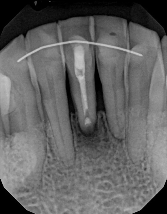 The image shows an X-ray of a dental implant with a metal rod inserted into the jawbone, indicating a dental implantation process in progress.