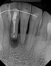 The image shows an X-ray with a visible toothbrush inside the mouth of a person, displaying dental structures such as teeth, roots, and gums.