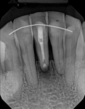 The image shows a close-up X-ray film with an oral cavity, displaying teeth and dental structures, with a metal wire or device inserted horizontally across the lower teeth, possibly for orthodontic purposes.