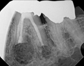 The image shows a dental X-ray with two distinct sets of teeth visible, one on the top and one on the bottom, against a black background.