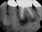 The image shows a close-up view of a dental X-ray with teeth and roots visible, revealing the internal structure of the mouth and teeth.