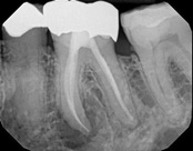 The image shows a dental X-ray with multiple teeth, some of which appear damaged or decayed, with annotations highlighting specific areas of interest.