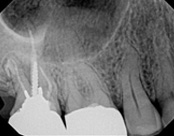 The image shows a dental X-ray with two front teeth prominently visible, along with other teeth and parts of the upper jaw.
