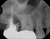 The image shows an X-ray of a dental implant with surrounding teeth and bone structure visible, providing a detailed view of oral health.