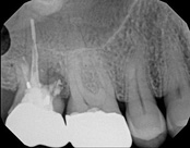 This is an X-ray image showing a dental implant with surrounding teeth and gum tissue.