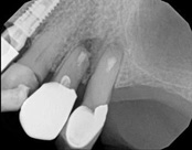 The image shows an X-ray of a human mouth with teeth and dental implants, viewed from above.