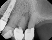 The image displays an X-ray with a partial view of a dental implant, showing screws and some surrounding teeth, along with a small portion of the upper jaw and part of a toothbrush.