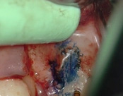 The image shows a close-up view of an open mouth with a surgical instrument inserted into the cavity, revealing exposed teeth and gum tissue with visible stitches and swelling.