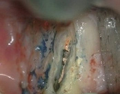 The image depicts a close-up view of an open mouth with a tooth extraction site, showing exposed bone and surrounding tissue, possibly indicating post-surgical healing or infection.