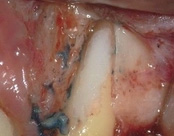 The image shows an open mouth with visible teeth, tongue, and interior oral structures, including a section of the tongue with a large, blackened area and a tooth with discoloration and decay.