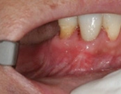 The image shows an open mouth with visible teeth and gums, displaying signs of inflammation or infection, such as redness and swelling, which could indicate a dental condition like gingivitis or periodontitis.