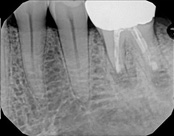 X-ray showing a dental implant with surrounding teeth.