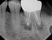 The image shows a medical X-ray with several teeth visible, including a tooth with a large filling and another with a small filling, along with dental implants and a partial denture.