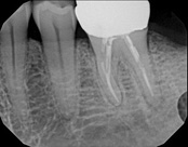 The image shows a dental X-ray with multiple teeth visible, including some with fillings, and a small object labeled 'Toothbrush' on the right side of the X-ray.