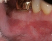 The image shows a close-up view of an open mouth with visible teeth and gums, featuring a large area of inflammation and redness, possibly indicating an infection or condition affecting the oral cavity.