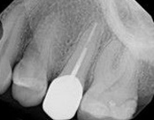 The image shows a close-up view of a dental implant being placed into a prepared tooth socket with an X-ray visible in the background, highlighting the procedure.