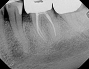 The image shows a close-up view of a dental X-ray with a focus on a lower jaw, revealing a tooth with a visible crack and a filling, alongside part of an upper jaw with teeth and gumline.