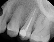 An X-ray image showing a close-up view of a dental implant being inserted into a jawbone.