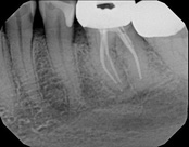 The image shows a dental X-ray with multiple teeth visible, including a prominent front tooth with a large cavity and some missing enamel, and a lower jaw with several other teeth, including one that appears to be an implant due to its different shape and color.