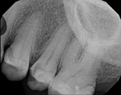 The image shows a close-up X-ray of a human mouth with visible teeth, gums, and some dental work, possibly including braces or orthodontic appliances.