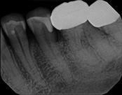 The image displays an X-ray of a human tooth with a visible cavity, showcasing dental decay and potential oral health issues.